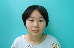 8岁女孩外斜视，散光---训练后眼球复位，双眼裸眼1.0