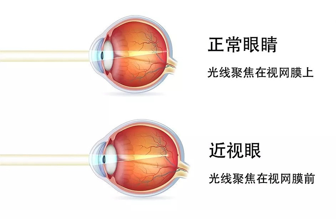 近视眼轴成像.jpg