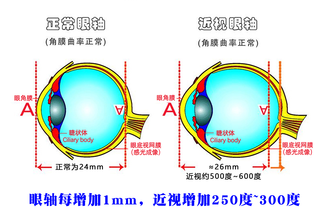 1684641263653942.jpg 26mm眼轴.jpg